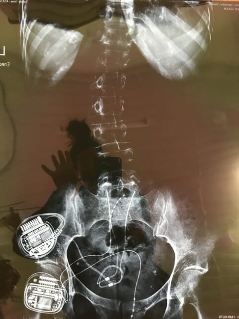 Implant shift2