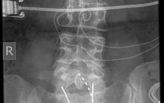 Spinal Stim Trial 02
