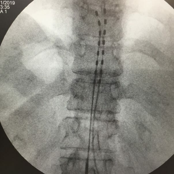 Spinal Stim implant xrays – 2